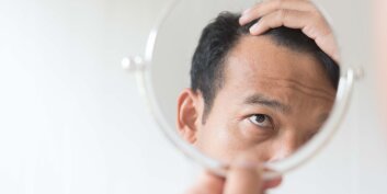 Comment prévenir et soigner la calvitie chez les hommes ?