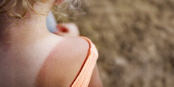 Tout savoir sur le coup de soleil pour mieux s'en protéger