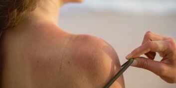 Coup de soleil, patience pendant au moins cinq jours !