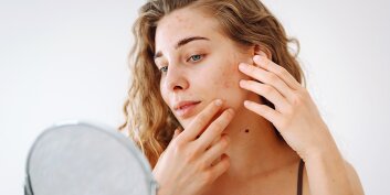 Peau acnéique ? Découvrez les secrets d'une approche douce et naturelle