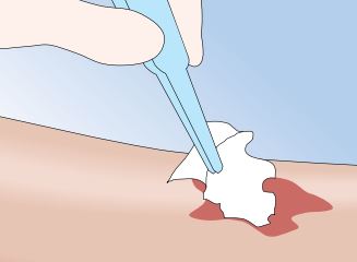 Mepilex Melgisorb Ag Antimikrobieller Alginatverband Steril 5x5cm St&uuml;ck 10 - Onlineapotheke - 6