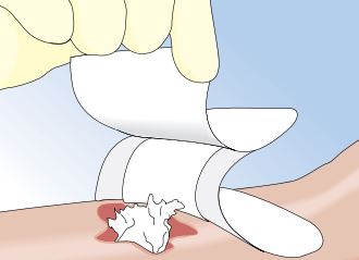 Mepilex Melgisorb Ag Antimikrobieller Alginatverband Steril 5x5cm St&uuml;ck 10 - Onlineapotheke - 7